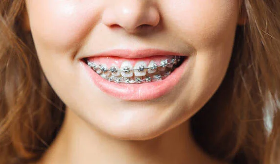 Metal and Ceramic Braces at Corona District