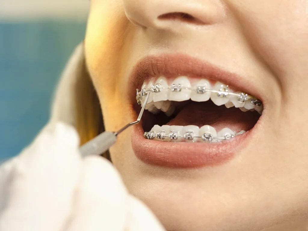 Factors of Adult Braces