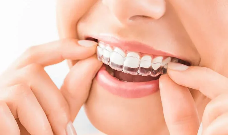 Invisalign and other Removable Braces in Richmond Hills