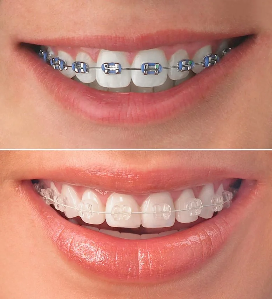 metal ceramic braces