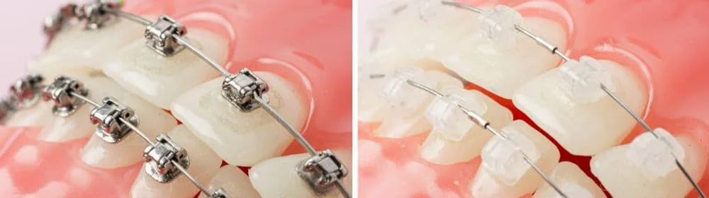 Metal & Ceramic Braces in Richmond Hills