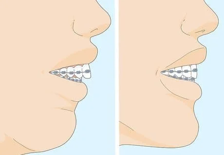 braces for overbite lips