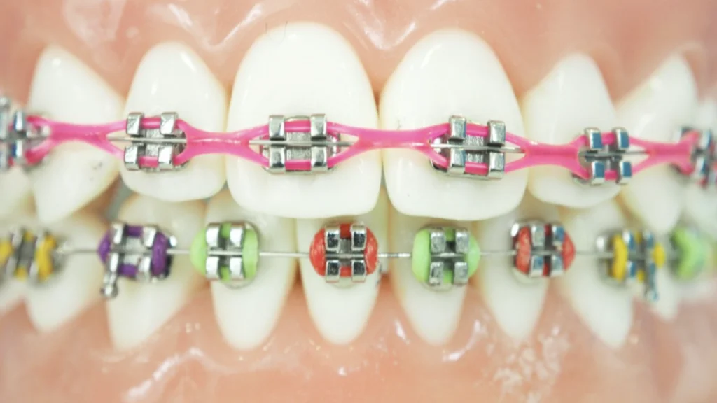 color braces that look good