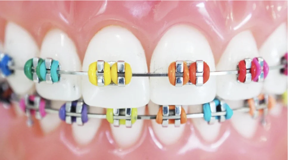 teeth braces color choosing colors look good