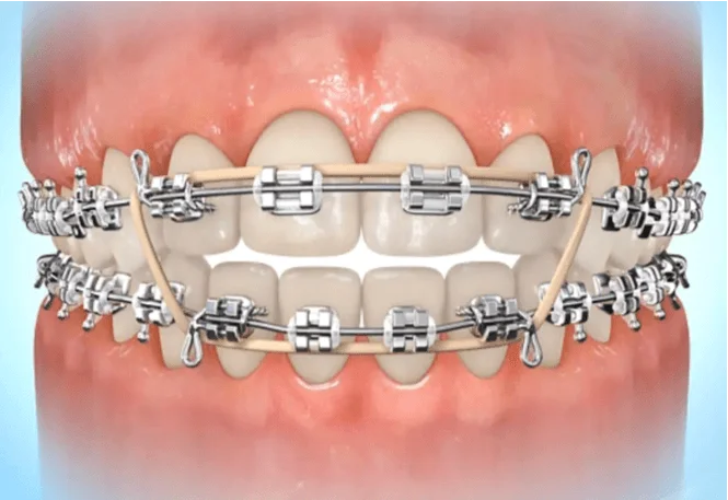 Braces with elastic bands used for orthodontic treatment adjustments