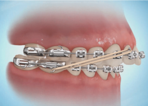 Different Types of Elastics for Braces