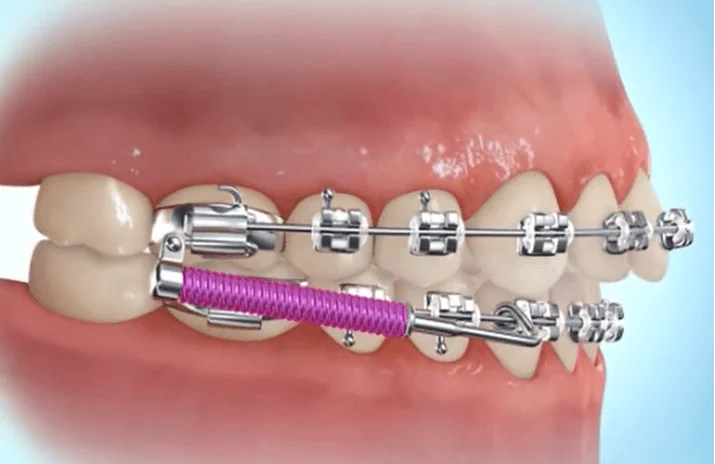Metal springs in braces to help with orthodontic adjustments