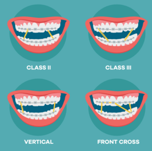 Purpose of Braces Rubber Bands