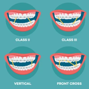 Purpose of Braces Rubber Bands