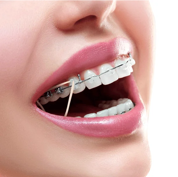Tooth rubber band: Unassociated group of braces for orthodontic treatment
