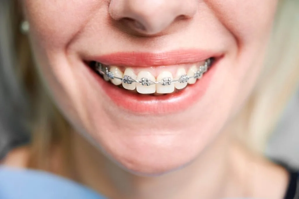 Silver braces bands used in orthodontic treatment