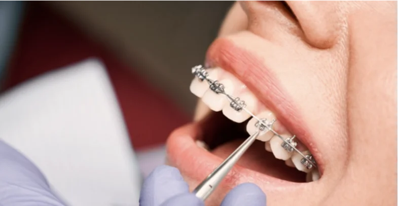 How Do Orthodontists Tighten Braces