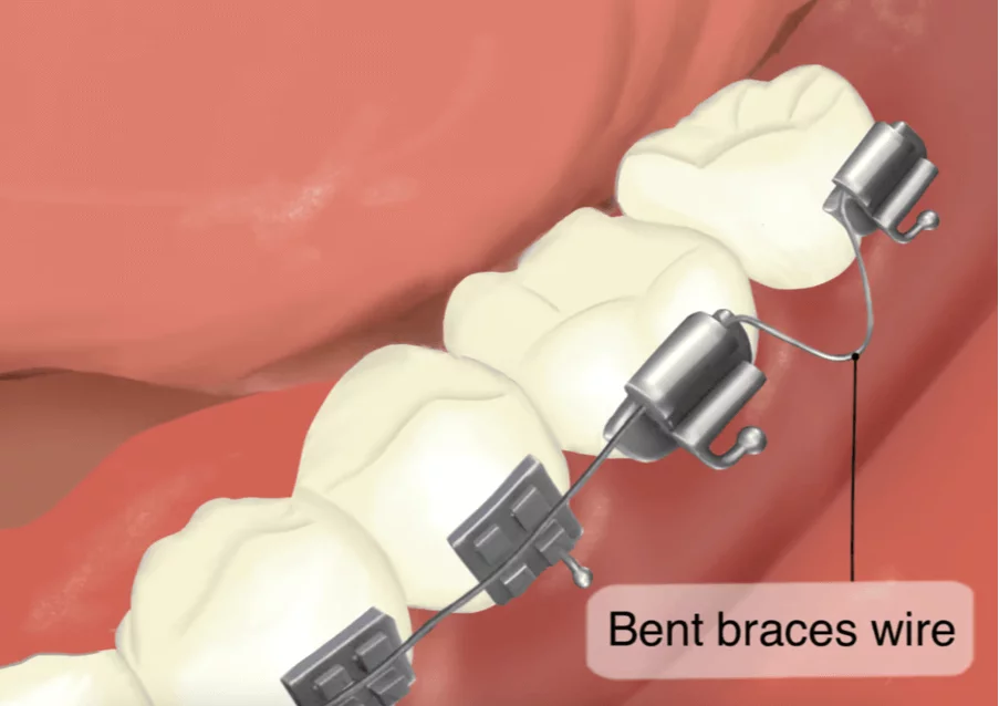 What to do if your braces wire bends and how to handle it properly