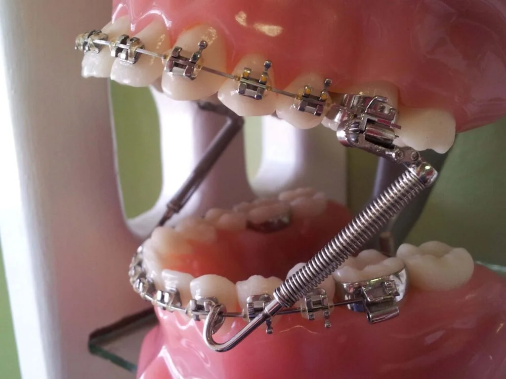 Springs in braces for enhancing orthodontic treatment