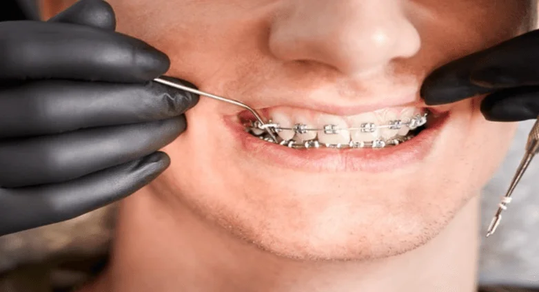 What To Do If You Bend Your Braces Wire