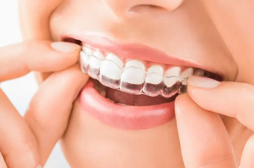 A person putting on their Invisalign aligners, highlighting dental care services in Queens, NY.