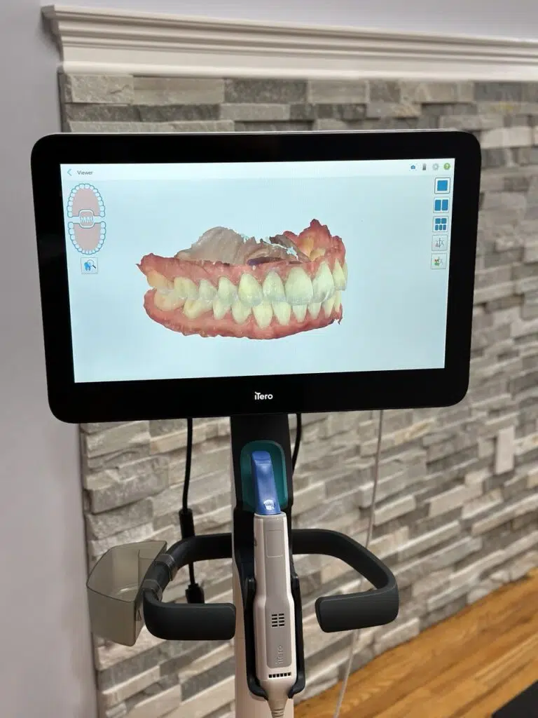 Orthodontist using the iTero Intraoral Scanner for digital dental impressions